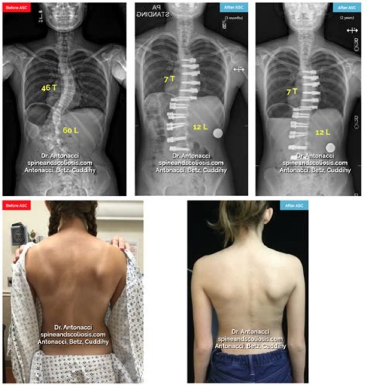 Ultimate Guide To Scar Scoliosis Surgery: Healing And Recovery